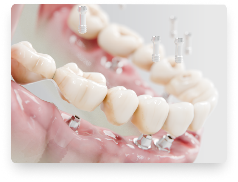 Teeth with implants and pink gums.