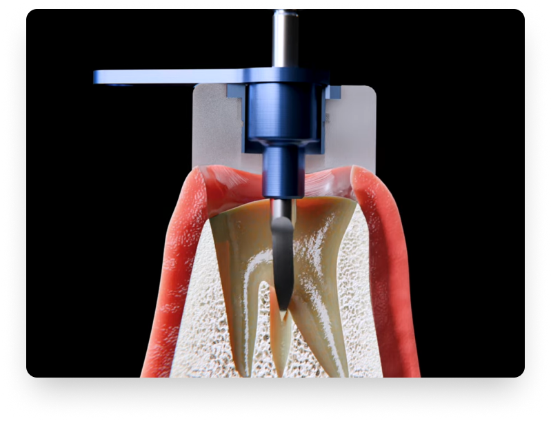 Tooth drilled into the root render.