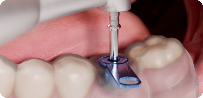 Dental implant being implanted into a jaw.