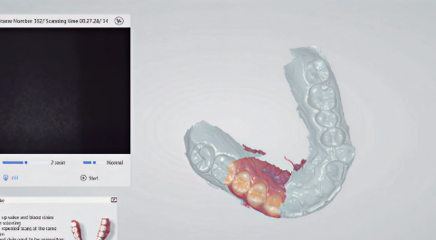 3D Render using Intraoral Scanner