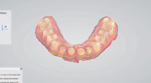 Computer render of gums.