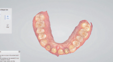 Intraoral Scanner render of gums.