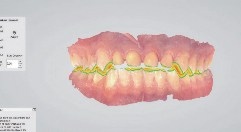 Computer render of teeth and gums.