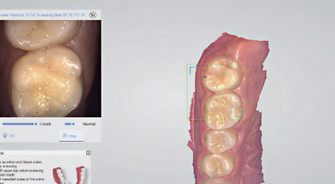 Scan on the top of teeth.