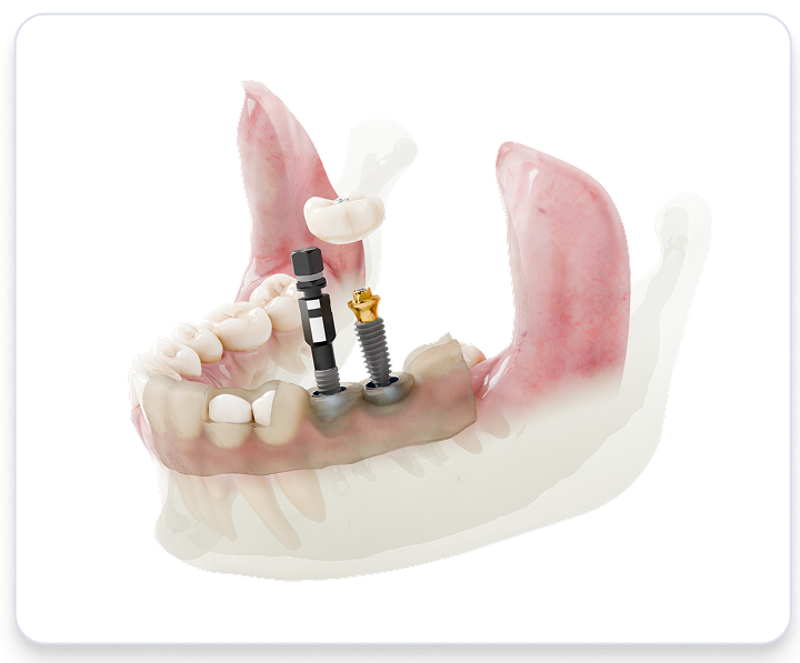 Dental bridge with screws in the jaw.